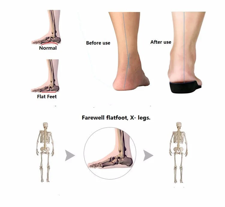 Flat Foot Arch Support Orthopedic Insoles Men Women Shoes Pad Sweat Shock Absorption Breathable Sports Insoles Orthotic Devices